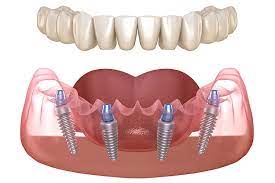 All on 4 dental impamts at The Tooth Corner Jorhat