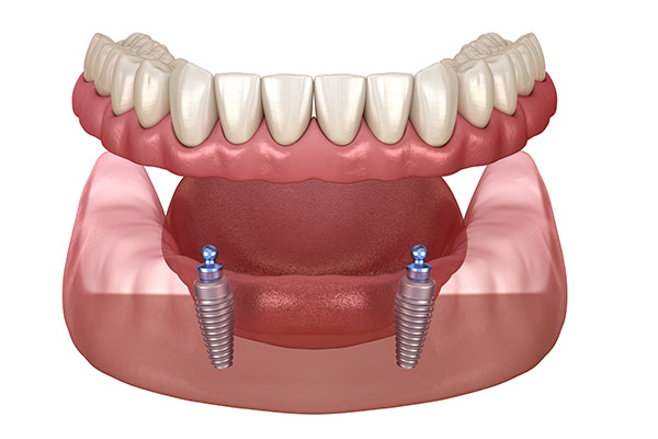 implant over denture at The Tooth Corner Jorhat